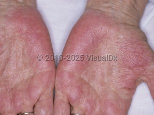 Clinical image of Palmar erythema - imageId=4791799. Click to open in gallery.  caption: 'Widespread red and violaceous patches on the palms.'