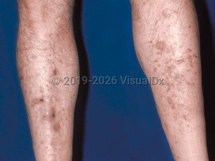 Diabetic dermopathy
