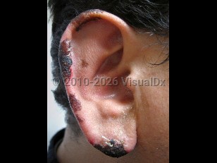 Cocaine levamisole toxicity