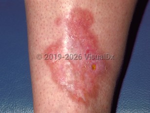Necrobiosis lipoidica