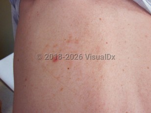 IgA pemphigus