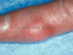 melanotic whitlow pictures Herpetic Condition, Treatments and for Adults Acquired Melanonychia | New England