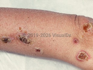 Mycobacterium avium-intracellulare infection