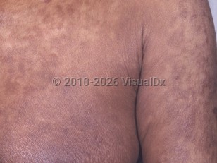 Clinical image of Angioimmunoblastic lymphadenopathy - imageId=4955382. Click to open in gallery.  caption: 'Widespread brown and violaceous, scaly plaques on the chest and arm.'