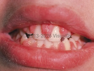 Gingival enlargement