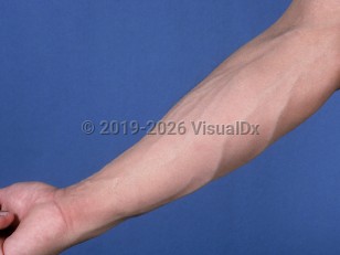 Drug-induced lipodystrophy