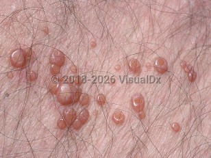 Molluscum contagiosum