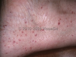 Hyperglobulinemic purpura of Waldenström