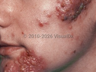 Clinical image of Pyoderma faciale - imageId=52544. Click to open in gallery.  caption: 'Large, boggy, inflammatory plaques with overlying and surrounding pustules and crusting on the lower face.&nbsp;'