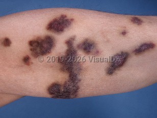 AIDS-associated Kaposi sarcoma