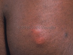 Clinical image of Arthropod bite or sting - imageId=531756. Click to open in gallery.  caption: 'A close-up of two markedly edematous pink nodules on the buttock of an immunocompromised patient.'