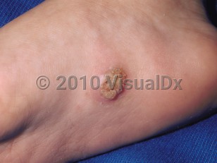 Plantar wart