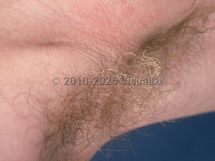 Clinical image of Trichomycosis axillaris - imageId=536988. Click to open in gallery.  caption: 'Adherent, yellowish concretions around numerous hair shafts in the axilla.'