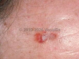 Nodular amyloidosis