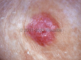 Paget disease of breast