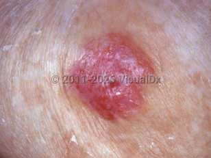 Paget disease of breast