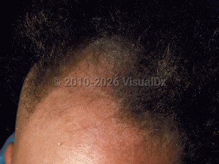 Clinical image of Menkes syndrome - imageId=54115. Click to open in gallery.  caption: 'Short, twisted hairs on the anterior scalp.'
