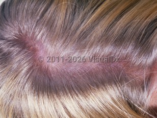 Clinical image of Phenylketonuria - imageId=5455459. Click to open in gallery.  caption: 'Diet-related hair color change in a patient with phenylketonuria.'