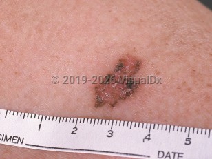 Clinical image of Pigmented basal cell carcinoma - imageId=547363. Click to open in gallery.  caption: 'A close-up of a pink plaque with overlying scale and brown and gray borders.'