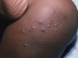 Clinical image of Echovirus infection - imageId=5509254. Click to open in gallery.  caption: 'Numerous papules and papulovesicles of varying sizes, some with central crusts, on the knee.'