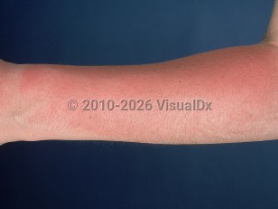 Sunburn