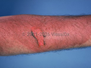 Clinical image of Thermal or electrical burn - imageId=556861. Click to open in gallery.  caption: 'An extensive reddish-brown, wrinkled, eroded plaque on the arm.'