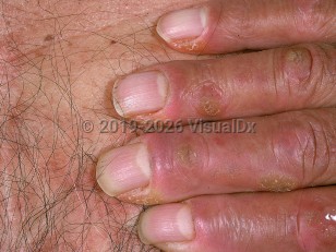 Acrokeratosis paraneoplastica