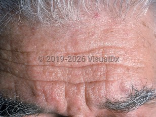 Clinical image of Trichodiscoma - imageId=568319. Click to open in gallery.  caption: 'Many subtle whitish papules on the forehead.'
