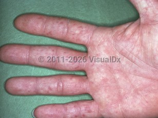 Clinical image of Cold agglutinin disease - imageId=5702275. Click to open in gallery.  caption: 'Reddish and purpuric macules on the fingers secondary to cold agglutinin disease.'