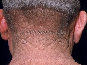 Cutis rhomboidalis nuchae