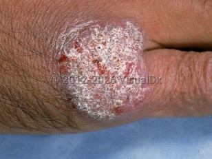 Chromoblastomycosis