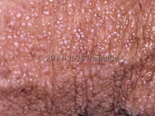 Colloid milium