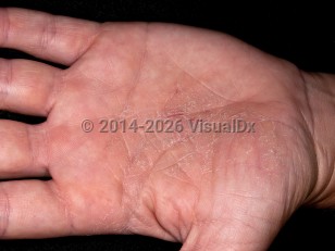 Clinical image of Hand eczema - imageId=5794559. Click to open in gallery.  caption: 'An ill-defined scaly and fissured plaque on the palm.'
