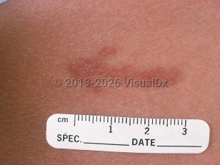 Caterpillar dermatitis