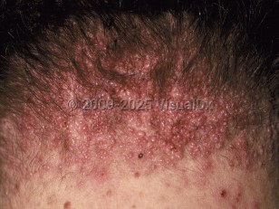Acne keloidalis nuchae