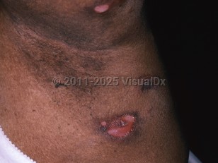Clinical image of Lymphomatoid granulomatosis - imageId=5924209. Click to open in gallery.  caption: 'Superficial ulcers and an atrophic scar in the axilla.'