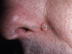 Trichoepithelioma