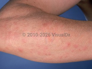 Autoimmune progesterone dermatitis