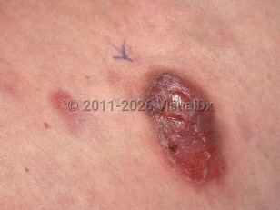 Interstitial granulomatous drug reaction