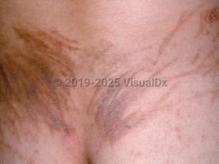 Drug-induced flagellate pigmentation