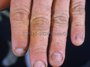 Epidermodysplasia verruciformis