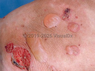 Epidermolysis bullosa acquisita