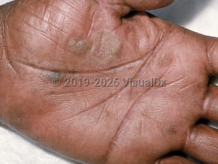 Epidermolysis bullosa simplex