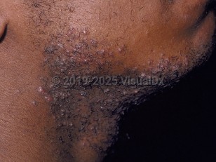 Pseudofolliculitis barbae