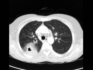Acinetobacter infection