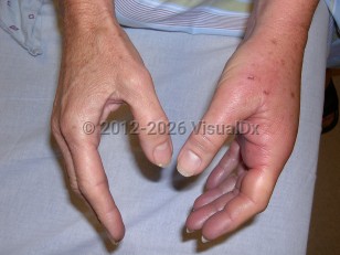 Animal bite infection