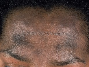Ashy dermatosis