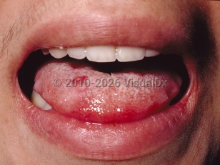 Behçet syndrome