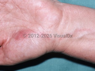Lymphangitis