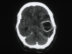 Brain abscess
